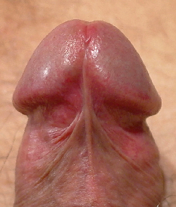 Beschneidung frenulum Circumcision