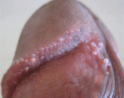 Pearly pinile papules
